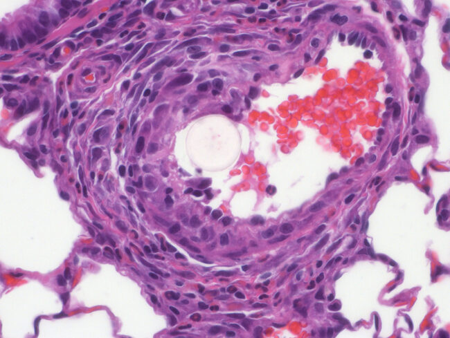 FB in artery 400x
